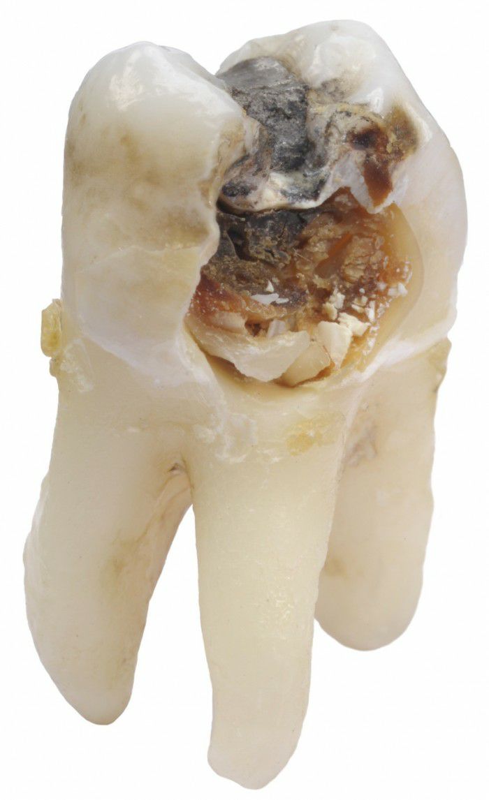 Tooth rot on a fruit diet?