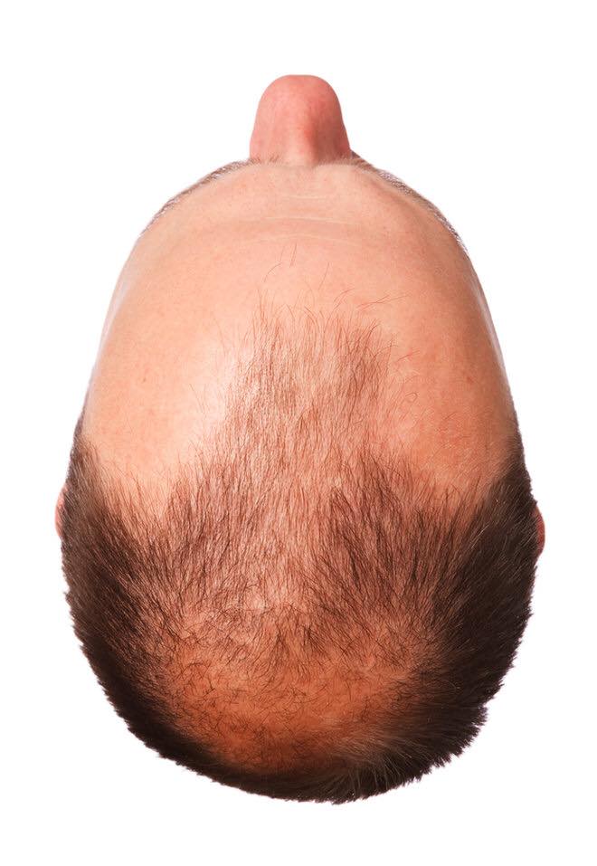 Male pattern baldness at a young age?