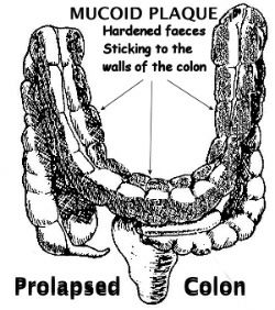 Don't try to gain weight while fixing malabsorption