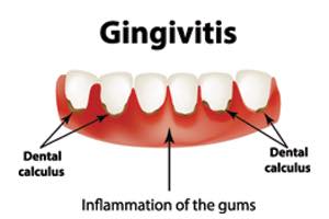 Gingivitis is it really a gum “disease”?