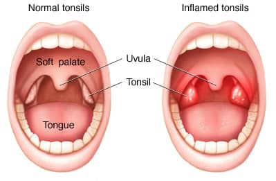 Removing Your child’s tonsils but not understanding the cause to why they are damaged?