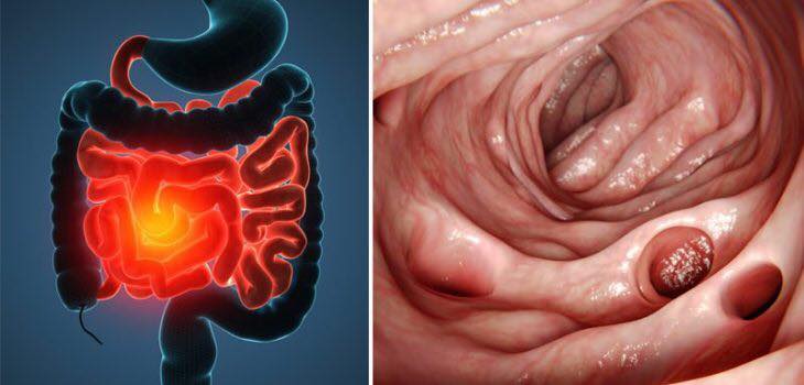 Diverticulitis Is not an autoimmune condition, and doesn’t require “treatment”