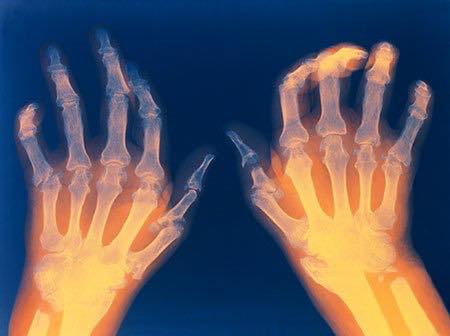 Rheumatoid arthritis (inflammation of the joints)