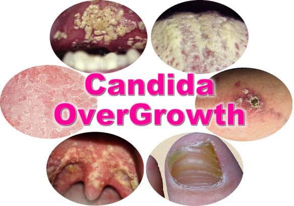 5 major factors that contribute to candida overgrowths in the body