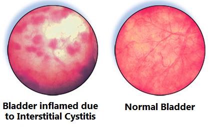 Interstitial cystitis, prostatitis, and how I reversed it