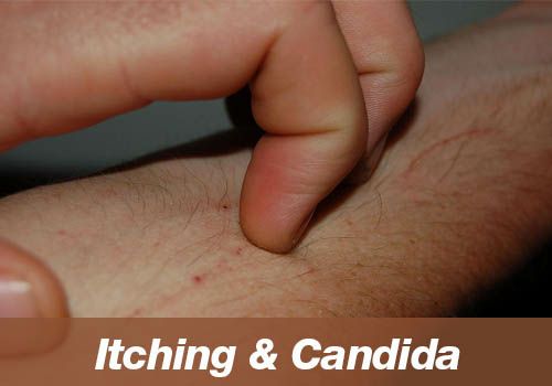 Excessive itching during detoxification? (candida)
