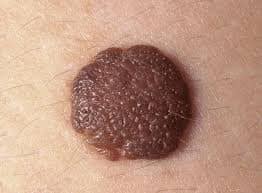 What are moles on the body caused from?