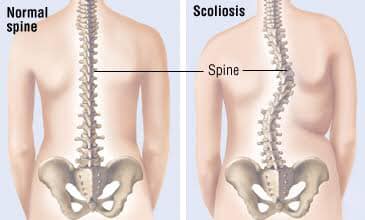 What causes scoliosis?