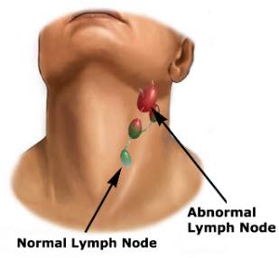 How to get rid of cysts, and swollen lymph nodes
