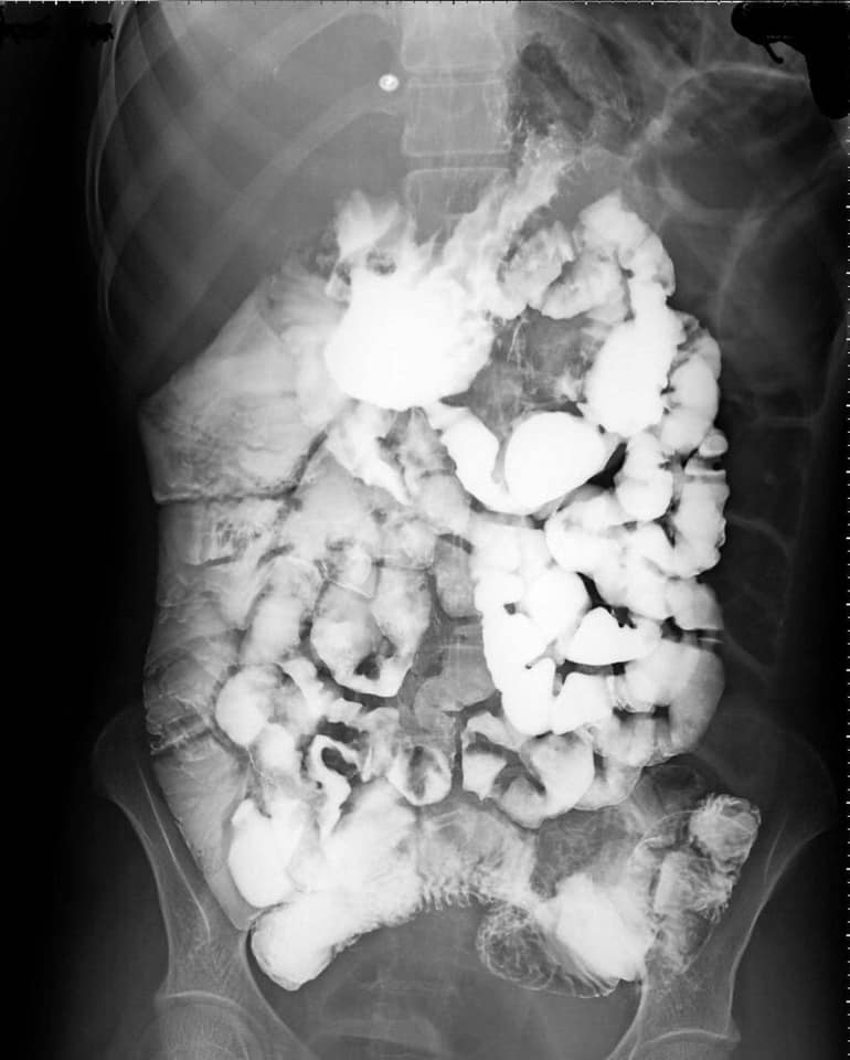 Malabsorption and knowing if you should build up on other foods other then just fruit