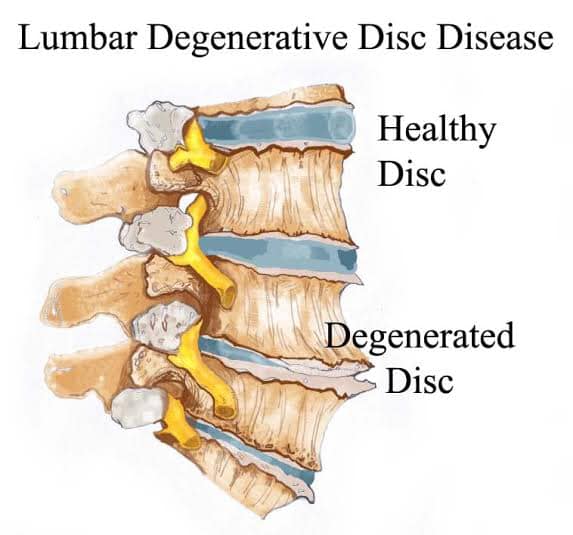 Degenerative disk “disease”