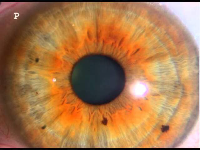 Sulfate congestion is shown in the iris