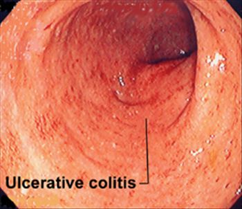 Ulcerative colitis is systemic acidosis