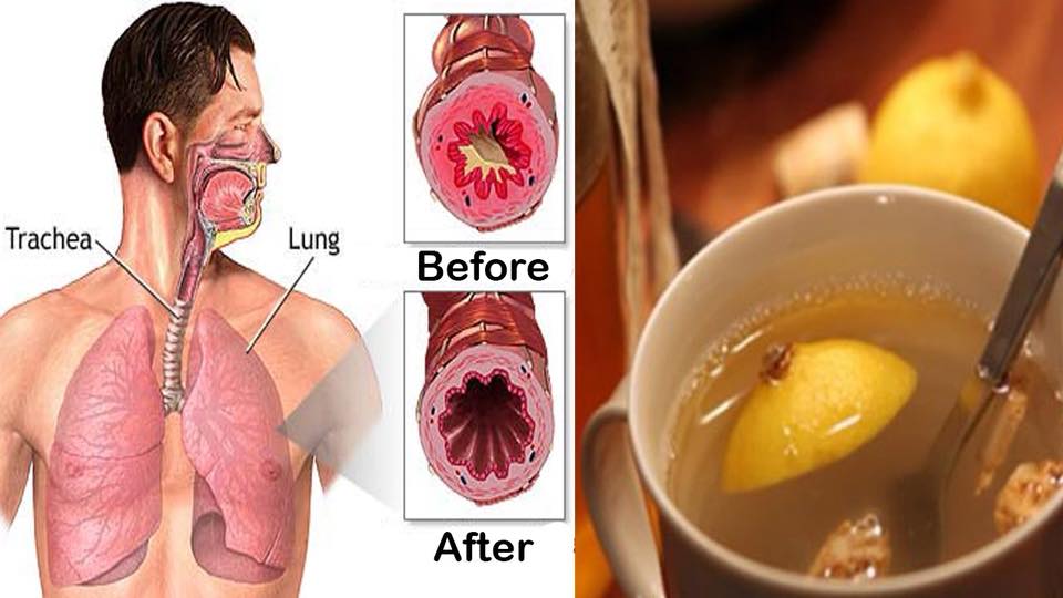 COPD (lungs full of mucus)