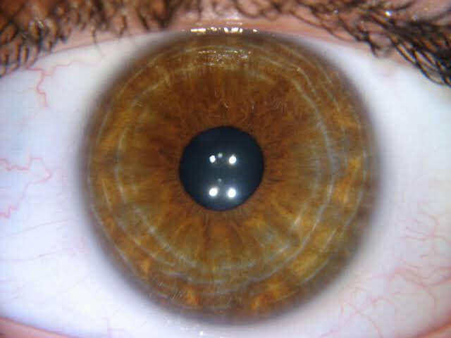 Nerve rings in the iris