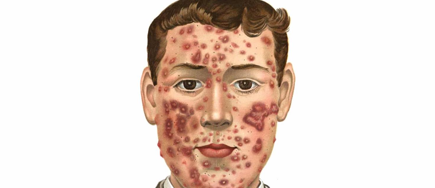 Acne is systemic acidosis
