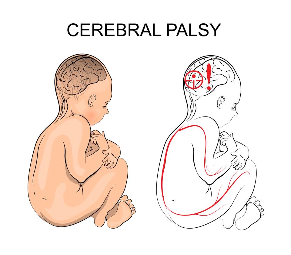 What causes cerebral palsy