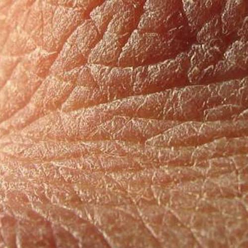 Connective tissue weakness and dehydration causes wrinkly skin