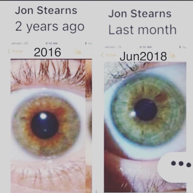 Observing my left iris before and after pics from 2016-2018
