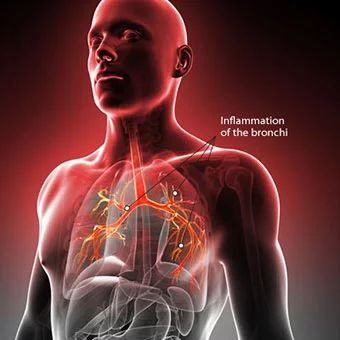 What causes bronchitis and lung congestion?