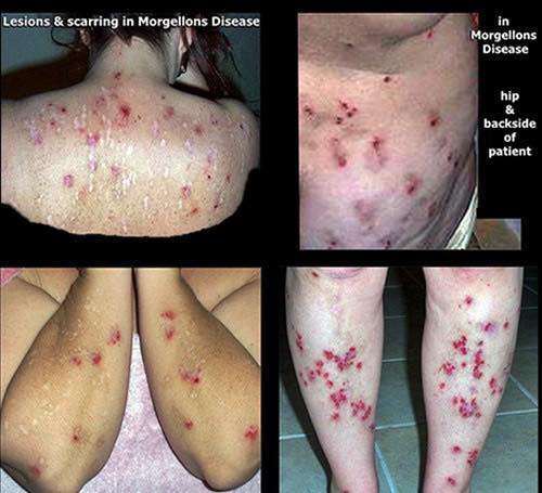 Morgellons disease